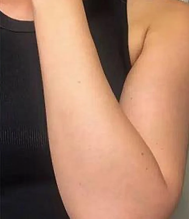 After treatment — Full Arms