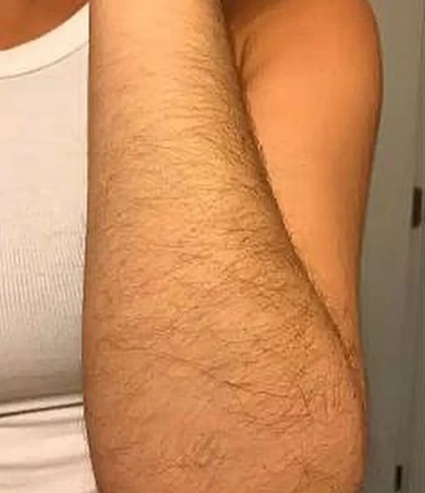 Before treatment — Full Arms
