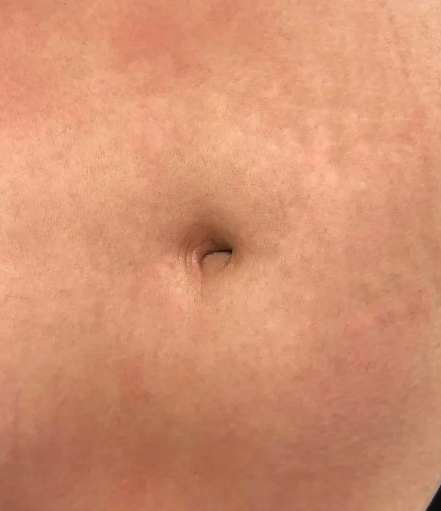 After treatment — Full Body