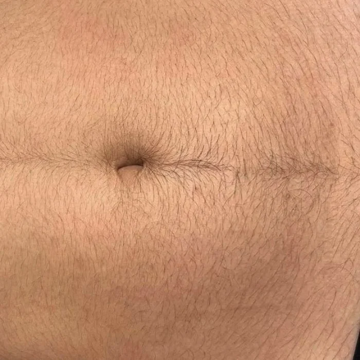 Before treatment — Full Body