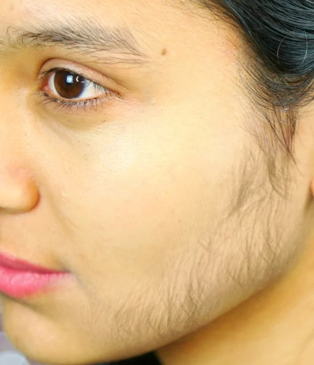 Before treatment — Full Face