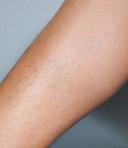 Before treatment — Full Legs