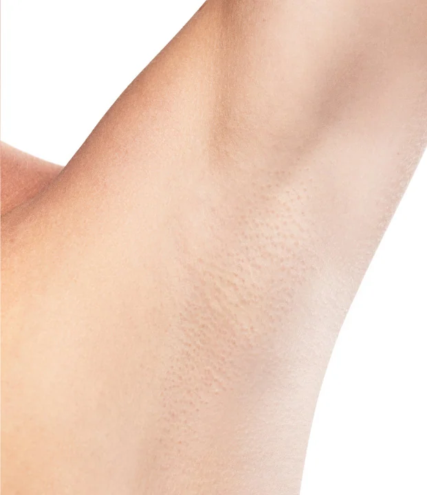 After treatment — Underarms