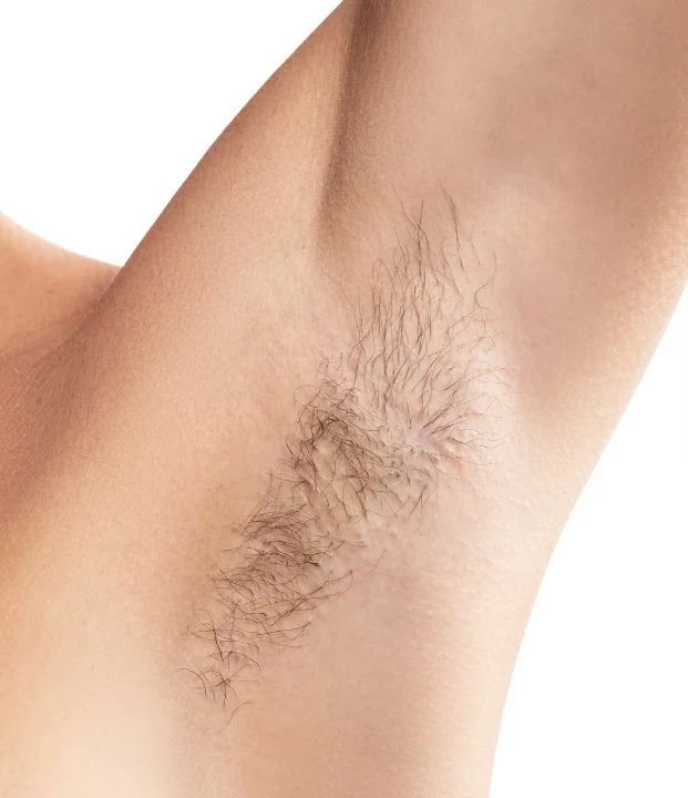 Before treatment — Underarms